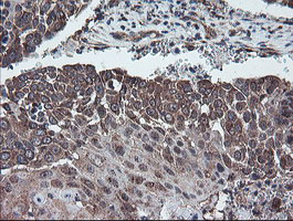 DPH2 Antibody - IHC of paraffin-embedded Carcinoma of Human lung tissue using anti-DPH2 mouse monoclonal antibody.
