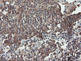 DPH2 Antibody - IHC of paraffin-embedded Carcinoma of Human bladder tissue using anti-DPH2 mouse monoclonal antibody.