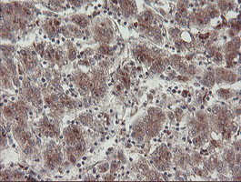 DPH2 Antibody - IHC of paraffin-embedded Carcinoma of Human liver tissue using anti-DPH2 mouse monoclonal antibody.