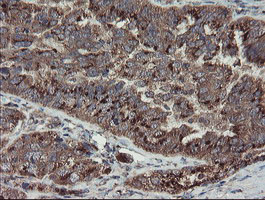 DPH2 Antibody - IHC of paraffin-embedded Adenocarcinoma of Human ovary tissue using anti-DPH2 mouse monoclonal antibody.