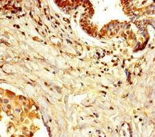 DPH7 / WDR85 Antibody - Immunohistochemistry of paraffin-embedded human breast cancer at dilution of 1:100