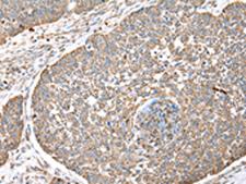 DPH7 / WDR85 Antibody - Immunohistochemistry of paraffin-embedded Human lung cancer tissue  using DPH7 Polyclonal Antibody at dilution of 1:40(×200)