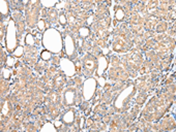 DPH7 / WDR85 Antibody - Immunohistochemistry of paraffin-embedded Human thyroid cancer tissue  using DPH7 Polyclonal Antibody at dilution of 1:40(×200)