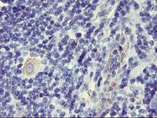 DPP9 Antibody - IHC of paraffin-embedded Human lymphoma tissue using anti-DPP9 mouse monoclonal antibody.