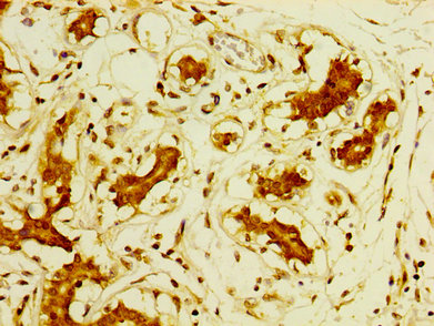 DPP9 Antibody - Immunohistochemistry image at a dilution of 1:800 and staining in paraffin-embedded human breast cancer performed on a Leica BondTM system. After dewaxing and hydration, antigen retrieval was mediated by high pressure in a citrate buffer (pH 6.0) . Section was blocked with 10% normal goat serum 30min at RT. Then primary antibody (1% BSA) was incubated at 4 °C overnight. The primary is detected by a biotinylated secondary antibody and visualized using an HRP conjugated SP system.