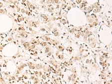 DPPA4 Antibody - Immunohistochemistry of paraffin-embedded Human breast cancer tissue  using DPPA4 Polyclonal Antibody at dilution of 1:55(×200)