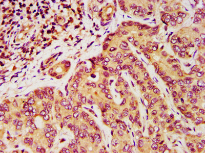 DPPA5 Antibody - Immunohistochemistry image at a dilution of 1:200 and staining in paraffin-embedded human liver cancer performed on a Leica BondTM system. After dewaxing and hydration, antigen retrieval was mediated by high pressure in a citrate buffer (pH 6.0) . Section was blocked with 10% normal goat serum 30min at RT. Then primary antibody (1% BSA) was incubated at 4 °C overnight. The primary is detected by a biotinylated secondary antibody and visualized using an HRP conjugated SP system.