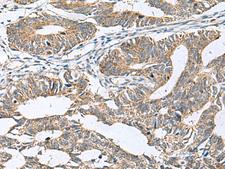 DPY19L3 Antibody - Immunohistochemistry of paraffin-embedded Human colorectal cancer tissue  using DPY19L3 Polyclonal Antibody at dilution of 1:120(×200)