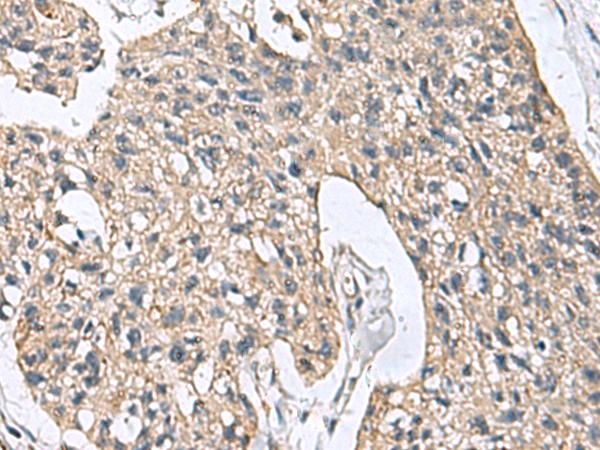 DPY19L3 Antibody - Immunohistochemistry of paraffin-embedded Human esophagus cancer tissue  using DPY19L3 Polyclonal Antibody at dilution of 1:110(×200)