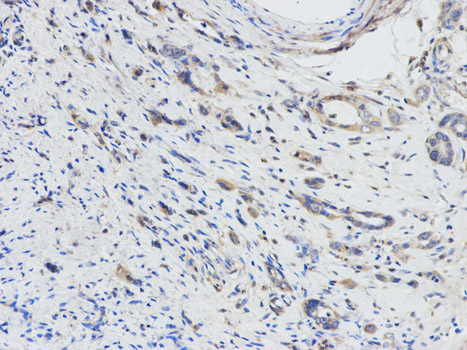 DPYD / DPD Antibody - Immunohistochemistry of paraffin-embedded human stomach cancer using DPYD antibody at dilution of 1:100 (200x lens).