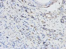 DPYD / DPD Antibody - Immunohistochemistry of paraffin-embedded human stomach cancer using DPYD antibody at dilution of 1:100 (200x lens).