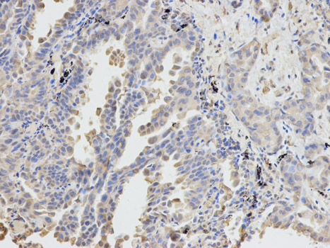 DPYD / DPD Antibody - Immunohistochemistry of paraffin-embedded human lung cancer using DPYD antibody at dilution of 1:100 (200x lens).
