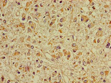 DPYSL2 / CRMP2 Antibody - Immunohistochemistry image of paraffin-embedded human glioma cancer at a dilution of 1:100