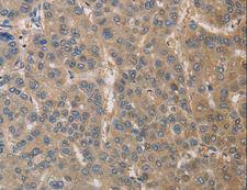 DPYSL3 / CRMP4 Antibody - Immunohistochemistry of paraffin-embedded Human liver cancer using DPYSL3 Polyclonal Antibody at dilution of 1:30.