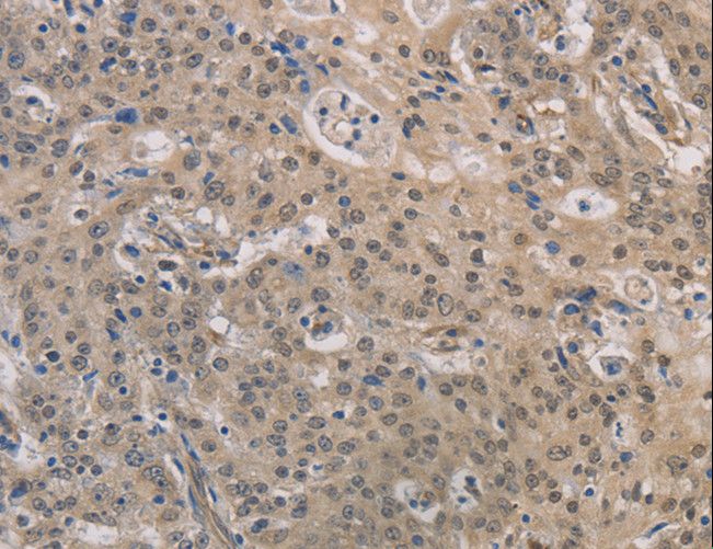 DPYSL3 / CRMP4 Antibody - Immunohistochemistry of paraffin-embedded Human gastric cancer using DPYSL3 Polyclonal Antibody at dilution of 1:30.
