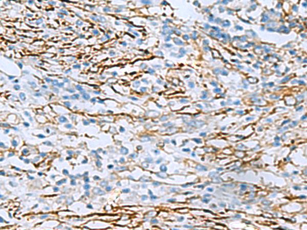 DPYSL3 / CRMP4 Antibody - Immunohistochemistry of paraffin-embedded Human breast cancer tissue  using DPYSL3 Polyclonal Antibody at dilution of 1:55(×200)