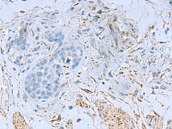 DPYSL3 / CRMP4 Antibody - Immunohistochemistry of paraffin-embedded Human esophagus cancer tissue  using DPYSL3 Polyclonal Antibody at dilution of 1:55(×200)