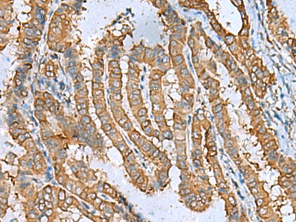 DPYSL3 / CRMP4 Antibody - Immunohistochemistry of paraffin-embedded Human thyroid cancer tissue  using DPYSL3 Polyclonal Antibody at dilution of 1:55(×200)