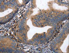DPYSL4 / CRMP3 Antibody - Immunohistochemistry of paraffin-embedded Human cervical cancer using DPYSL4 Polyclonal Antibody at dilution of 1:15.