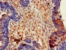 DPYSL4 / CRMP3 Antibody - Immunohistochemistry of paraffin-embedded human ovarian cancer using DPYSL4 Antibody at dilution of 1:100