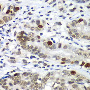 DR1 / NC2 Antibody - Immunohistochemistry of paraffin-embedded human gastric cancer tissue.