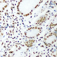DR1 / NC2 Antibody - Immunohistochemical analysis of DR1 staining in human gastric cancer formalin fixed paraffin embedded tissue section. The section was pre-treated using heat mediated antigen retrieval with sodium citrate buffer (pH 6.0). The section was then incubated with the antibody at room temperature and detected using an HRP conjugated compact polymer system. DAB was used as the chromogen. The section was then counterstained with hematoxylin and mounted with DPX.