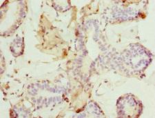 DR1 / NC2 Antibody - Immunohistochemistry of paraffin-embedded human breast cancer at dilution 1:100