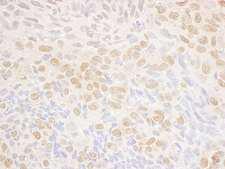 DRAK1 / STK17A Antibody - Detection of Human DRAK1 by Immunohistochemistry. Sample: FFPE section of human lung carcinoma. Antibody: Affinity purified rabbit anti-DRAK1 used at a dilution of 1:200 (1 ug/ml). Detection: DAB.