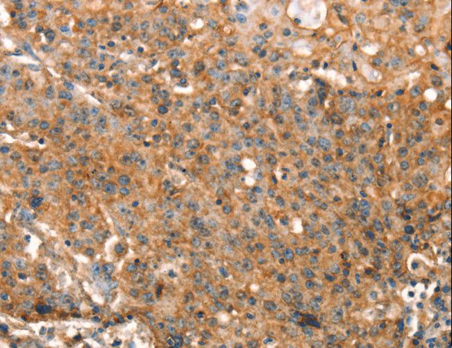 DRAK1 / STK17A Antibody - Immunohistochemistry of paraffin-embedded Human gastric cancer using STK17A Polyclonal Antibody at dilution of 1:25.