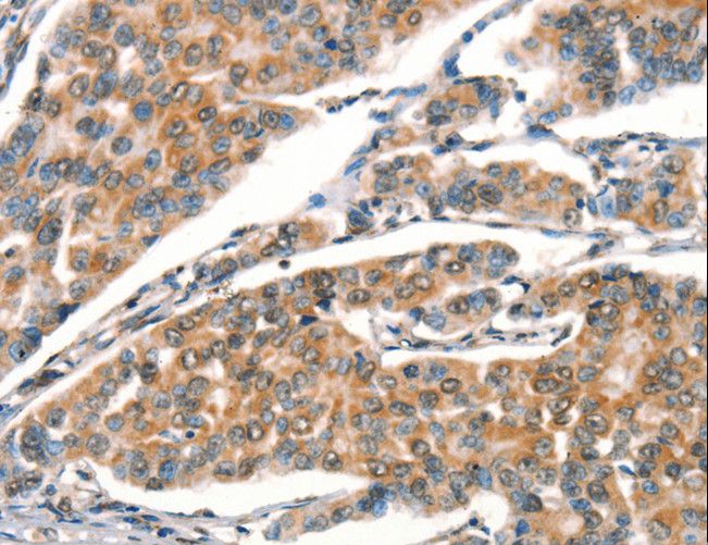 DRAK1 / STK17A Antibody - Immunohistochemistry of paraffin-embedded Human breast cancer using STK17A Polyclonal Antibody at dilution of 1:25.