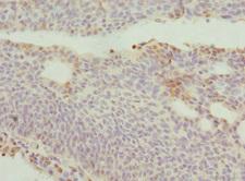 DRAM2 Antibody - Immunohistochemistry of paraffin-embedded human bladder cancer at dilution 1:100