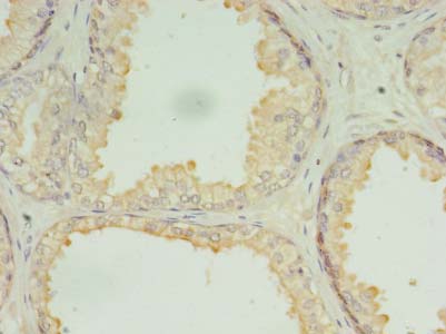 DRC7 / CCDC135 Antibody - Immunohistochemistry of paraffin-embedded human prostate cancer using antibody at dilution of 1:100.