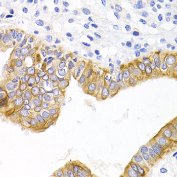 DRD1 / Dopamine Receptor D1 Antibody - Immunohistochemistry of paraffin-embedded human metrocarcinoma tissue.