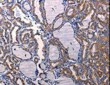 DRD1 / Dopamine Receptor D1 Antibody - Immunohistochemistry of paraffin-embedded Human thyroid cancer using DRD1 Polyclonal Antibody at dilution of 1:50.