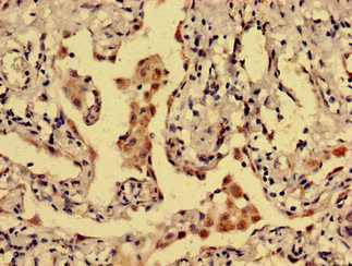 DRD1 / Dopamine Receptor D1 Antibody - Immunohistochemistry analysis of human lung cancer using DRD1 Antibody at dilution of 1:100