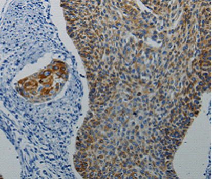 DRD4 / Dopamine Receptor D4 Antibody - Immunohistochemistry of paraffin-embedded human cervical cancer tissue using DRD4 antibody.