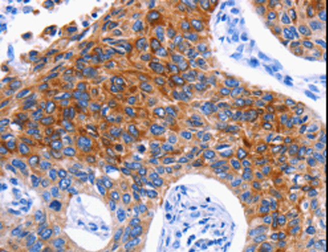 DRD4 / Dopamine Receptor D4 Antibody - Immunohistochemistry of paraffin-embedded Human lung cancer using DRD4 Polyclonal Antibody at dilution of 1:30.