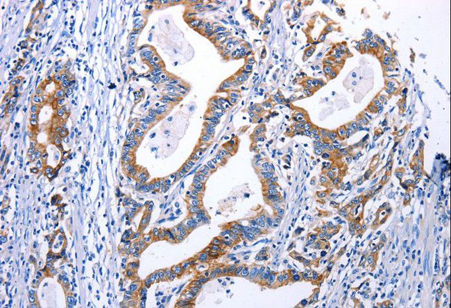 DRD4 / Dopamine Receptor D4 Antibody - Immunohistochemistry of paraffin-embedded Human gastric cancer using DRD4 Polyclonal Antibody at dilution of 1:30.