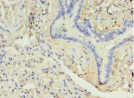 DRD5 / Dopamine Receptor D5 Antibody - Immunohistochemistry of paraffin-embedded human lung cancer tissue using antibody at 1: 100 dilution.  This image was taken for the unconjugated form of this product. Other forms have not been tested.