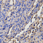DRD5 / Dopamine Receptor D5 Antibody - Immunohistochemistry of paraffin-embedded mouse lung metastasis using CHI3L1 antibody at dilution of 1:200 (x400 lens)