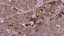 DRD5 / Dopamine Receptor D5 Antibody - 1:100 staining human liver carcinoma tissues by IHC-P. The sample was formaldehyde fixed and a heat mediated antigen retrieval step in citrate buffer was performed. The sample was then blocked and incubated with the antibody for 1.5 hours at 22°C. An HRP conjugated goat anti-rabbit antibody was used as the secondary.