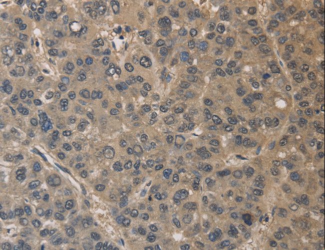 DRG1 / NEDD3 Antibody - Immunohistochemistry of paraffin-embedded Human liver cancer using DRG1 Polyclonal Antibody at dilution of 1:30.