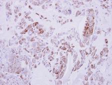 DRG2 Antibody - IHC of paraffin-embedded Lung ca, using DRG2 antibody at 1:500 dilution.