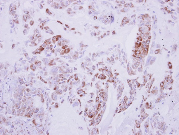 DRG2 Antibody - IHC of paraffin-embedded Lung ca, using DRG2 antibody at 1:500 dilution.