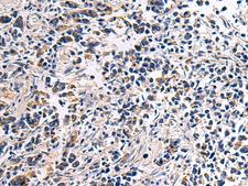 DRGX Antibody - Immunohistochemistry of paraffin-embedded Human breast cancer tissue  using DRGX Polyclonal Antibody at dilution of 1:45(×200)