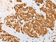 DRPLA / Atrophin-1 Antibody - Immunohistochemistry of paraffin-embedded Human thyroid cancer tissue  using ATN1 Polyclonal Antibody at dilution of 1:50(×200)