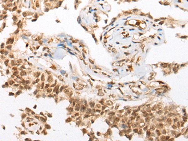DRPLA / Atrophin-1 Antibody - Immunohistochemistry of paraffin-embedded Human ovarian cancer tissue  using ATN1 Polyclonal Antibody at dilution of 1:50(×200)