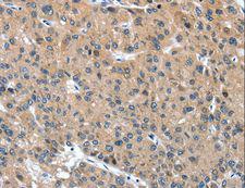 DSC1 / Desmocollin 1 Antibody - Immunohistochemistry of paraffin-embedded Human thyroid cancer using DSC1 Polyclonal Antibody at dilution of 1:40.