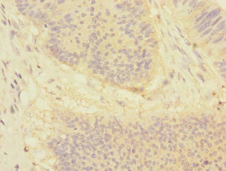 DSC1 / Desmocollin 1 Antibody - Immunohistochemistry of paraffin-embedded human colon cancer at dilution 1:100