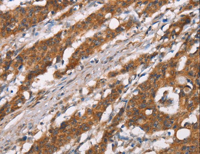 DSC2 / Desmocollin 2 Antibody - Immunohistochemistry of paraffin-embedded Human thyroid cancer using DSC2 Polyclonal Antibody at dilution of 1:35.